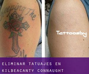 Eliminar tatuajes en Kilbeacanty (Connaught)