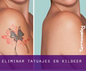 Eliminar tatuajes en Kildeer