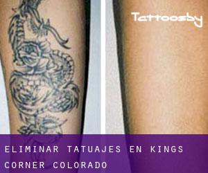 Eliminar tatuajes en Kings Corner (Colorado)