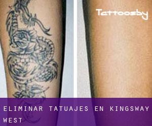 Eliminar tatuajes en Kingsway West