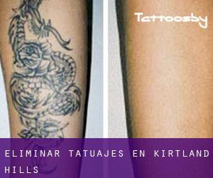 Eliminar tatuajes en Kirtland Hills