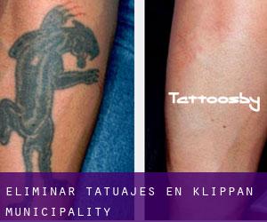 Eliminar tatuajes en Klippan Municipality