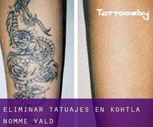 Eliminar tatuajes en Kohtla-Nõmme vald