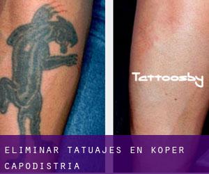 Eliminar tatuajes en Koper-Capodistria