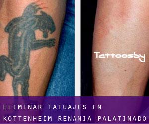 Eliminar tatuajes en Kottenheim (Renania-Palatinado)