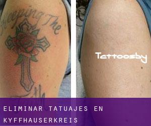 Eliminar tatuajes en Kyffhäuserkreis