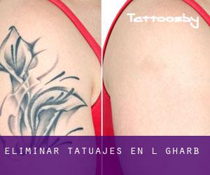 Eliminar tatuajes en L-Għarb