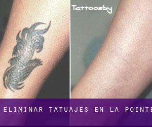 Eliminar tatuajes en La Pointe