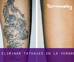 Eliminar tatuajes en La Vergne