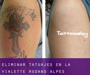 Eliminar tatuajes en La Vialette (Ródano-Alpes)