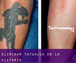 Eliminar tatuajes en La Victoria