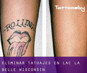 Eliminar tatuajes en Lac La Belle (Wisconsin)