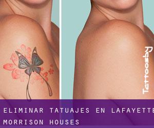Eliminar tatuajes en Lafayette Morrison Houses