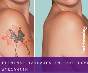 Eliminar tatuajes en Lake Como (Wisconsin)