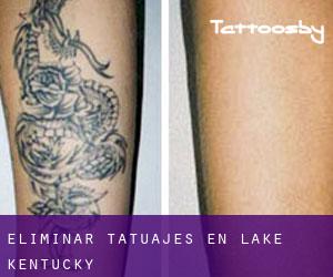 Eliminar tatuajes en Lake (Kentucky)