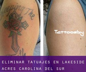 Eliminar tatuajes en Lakeside Acres (Carolina del Sur)