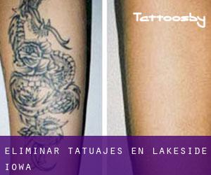 Eliminar tatuajes en Lakeside (Iowa)