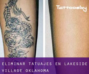 Eliminar tatuajes en Lakeside Village (Oklahoma)