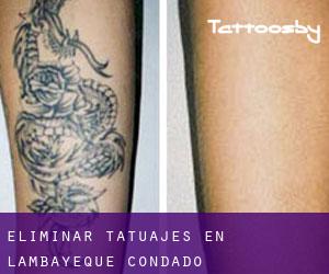 Eliminar tatuajes en Lambayeque (Condado)