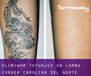 Eliminar tatuajes en Lambs Corner (Carolina del Norte)
