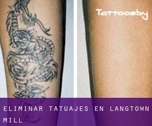 Eliminar tatuajes en Langtown Mill