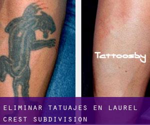Eliminar tatuajes en Laurel Crest Subdivision
