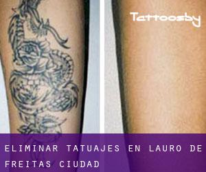 Eliminar tatuajes en Lauro de Freitas (Ciudad)
