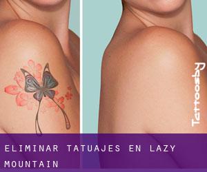 Eliminar tatuajes en Lazy Mountain
