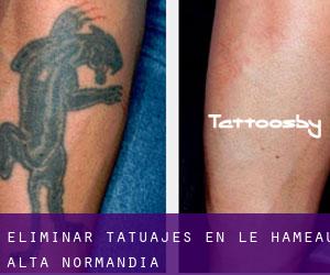 Eliminar tatuajes en Le Hameau (Alta Normandía)