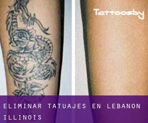 Eliminar tatuajes en Lebanon (Illinois)