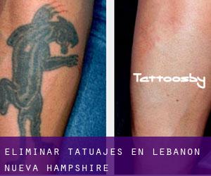 Eliminar tatuajes en Lebanon (Nueva Hampshire)