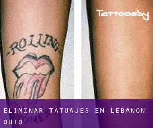 Eliminar tatuajes en Lebanon (Ohio)