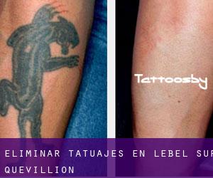 Eliminar tatuajes en Lebel-Sur-Quevillion