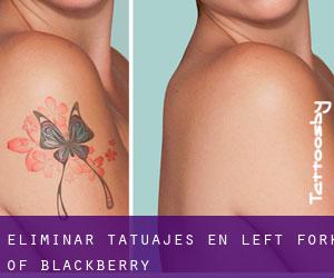 Eliminar tatuajes en Left Fork of Blackberry