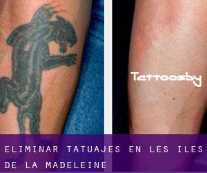 Eliminar tatuajes en Les Îles-de-la-Madeleine