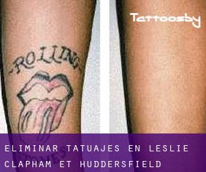 Eliminar tatuajes en Leslie-Clapham-et-Huddersfield