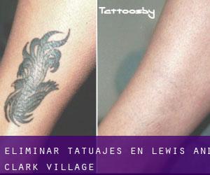 Eliminar tatuajes en Lewis and Clark Village
