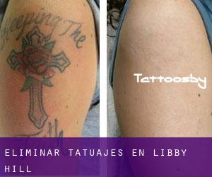 Eliminar tatuajes en Libby Hill