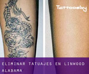 Eliminar tatuajes en Linwood (Alabama)