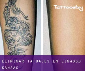 Eliminar tatuajes en Linwood (Kansas)