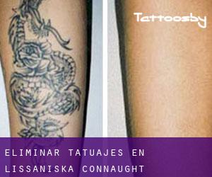 Eliminar tatuajes en Lissaniska (Connaught)