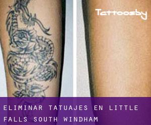 Eliminar tatuajes en Little Falls-South Windham