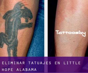 Eliminar tatuajes en Little Hope (Alabama)