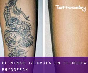 Eliminar tatuajes en Llanddewi Rhydderch