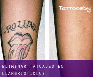 Eliminar tatuajes en Llangristiolus