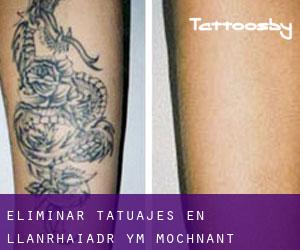 Eliminar tatuajes en Llanrhaiadr-ym-Mochnant