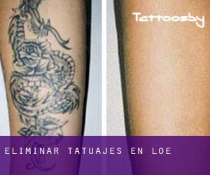 Eliminar tatuajes en Loe