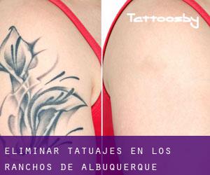 Eliminar tatuajes en Los Ranchos de Albuquerque