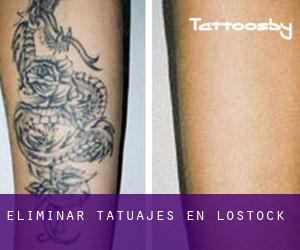 Eliminar tatuajes en Lostock