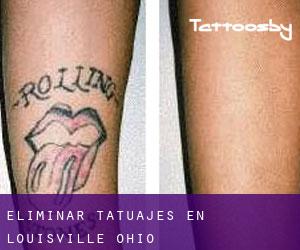Eliminar tatuajes en Louisville (Ohio)